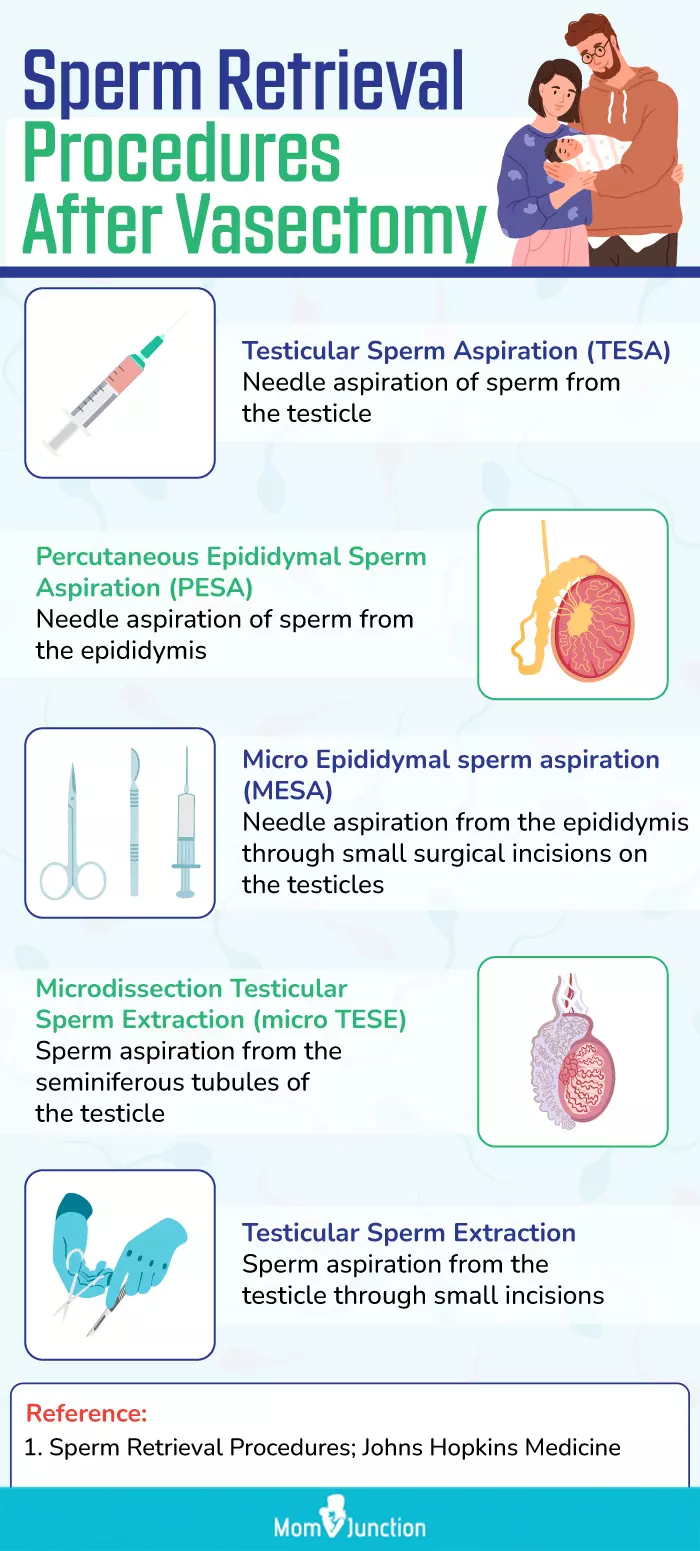 sperm retrieval procedures after vasectomy (infographic)