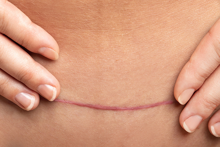 What To Look For With Your C-Section Scar