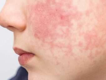 All You Need To Know About Fifth Diseases (Slapped Cheek Disease)