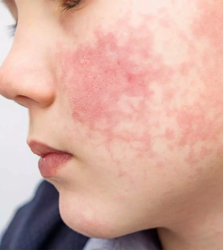 All You Need To Know About Fifth Diseases (Slapped Cheek Disease)
