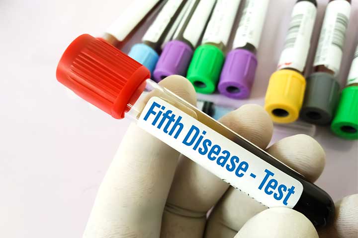 How Is Fifth Disease Diagnosed