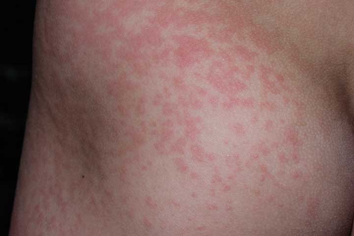 What Are The Symptoms Of Fifth Disease
