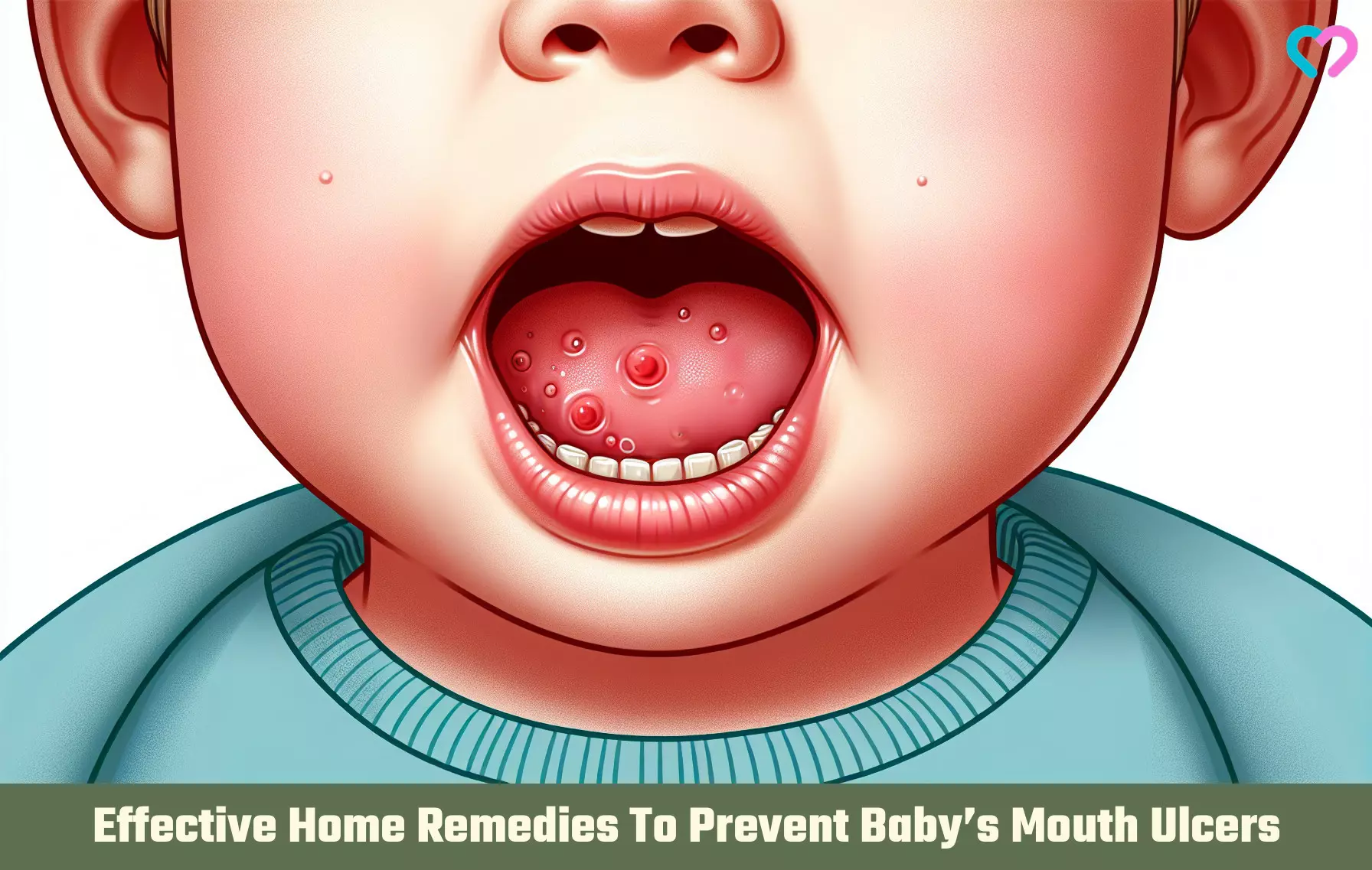 mouth ulcer in infants_illustration