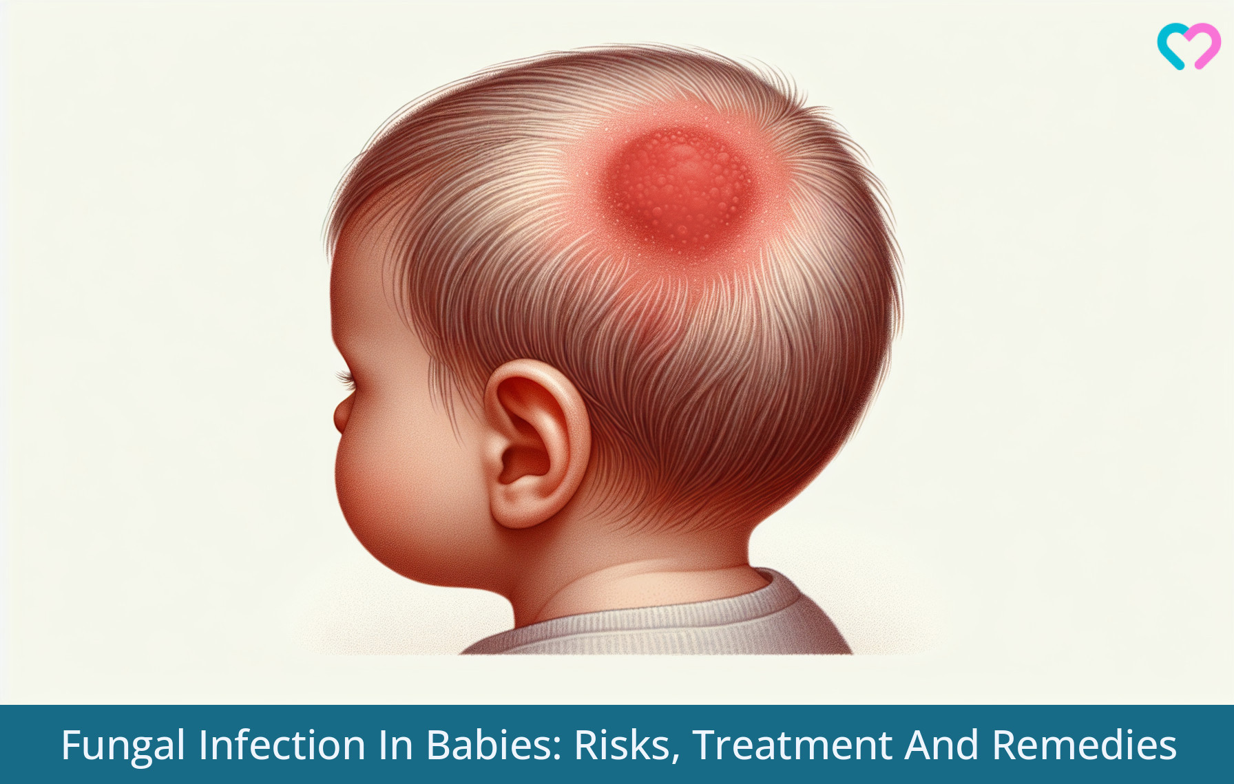 Fungal Infection In Babies_illustration
