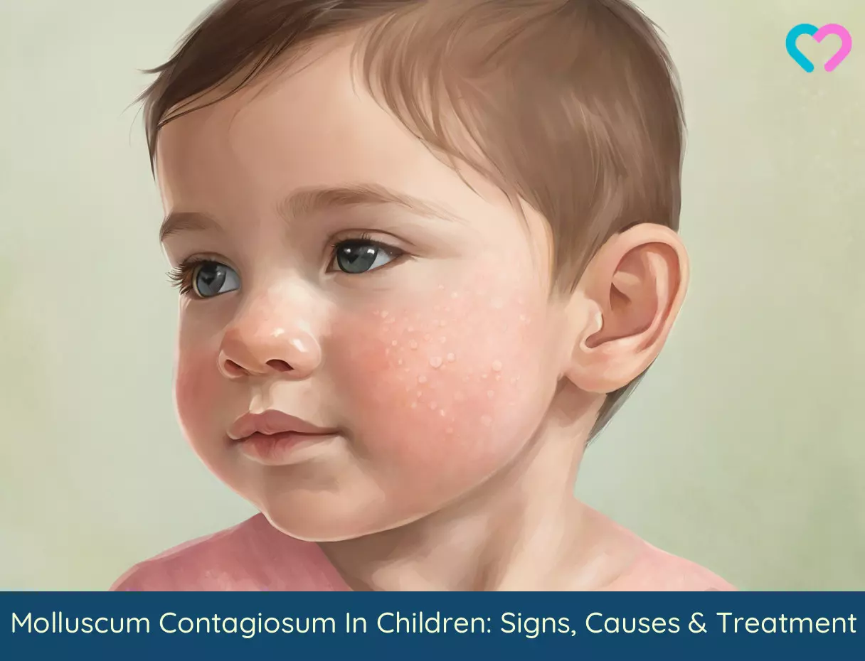 molluscum contagiosum in children_illustration