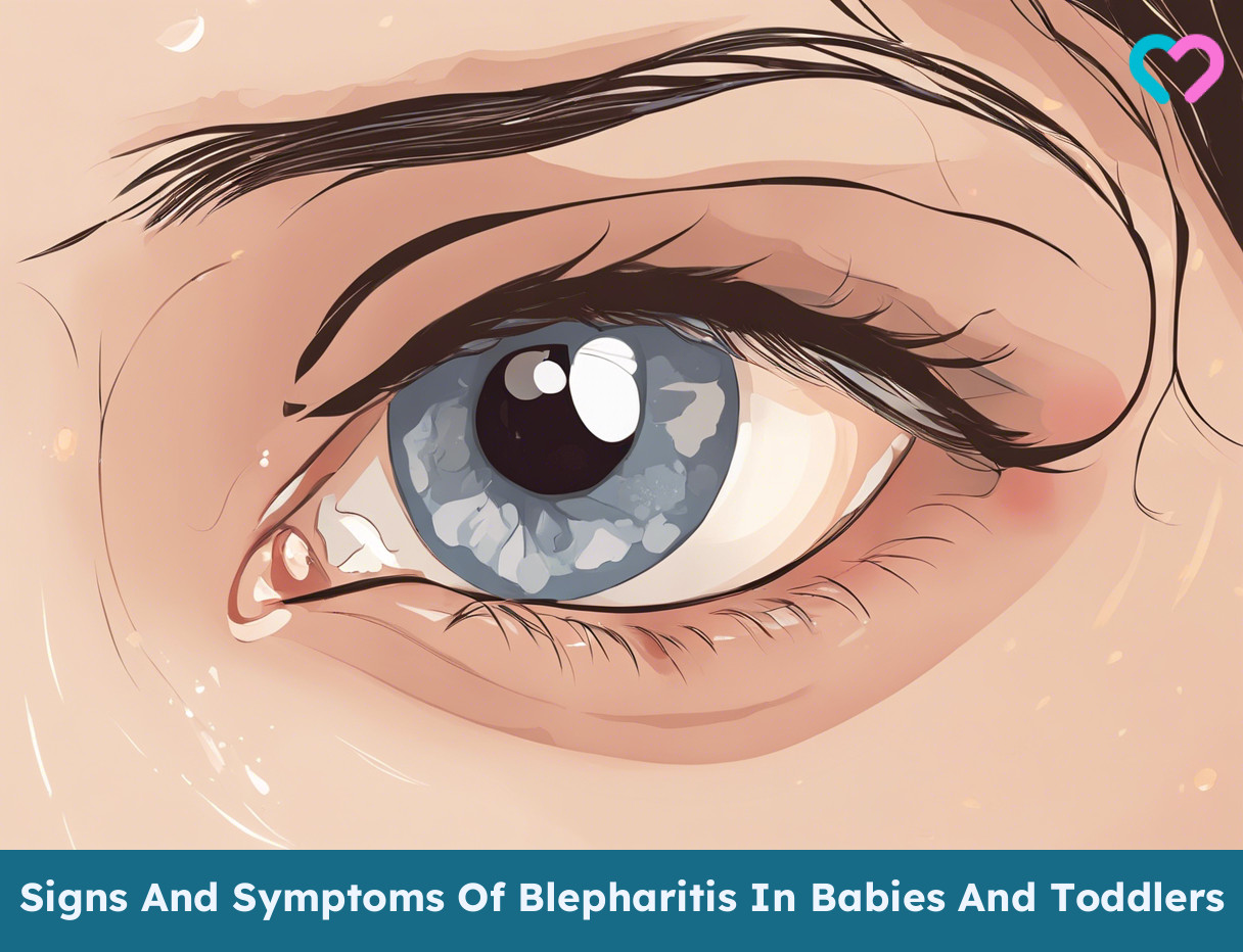 Blepharitis In Babies_illustration