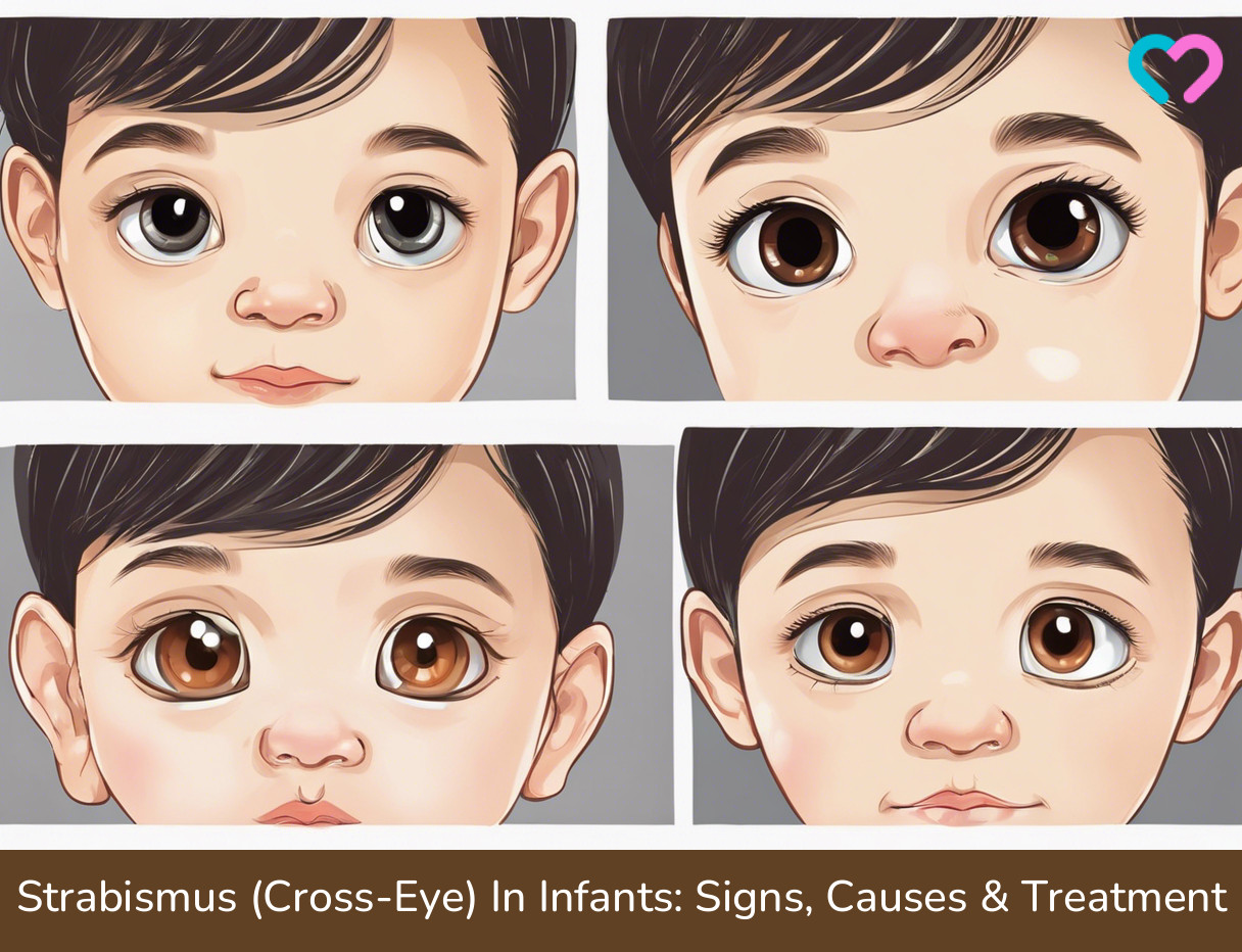 strabismus in infants_illustration