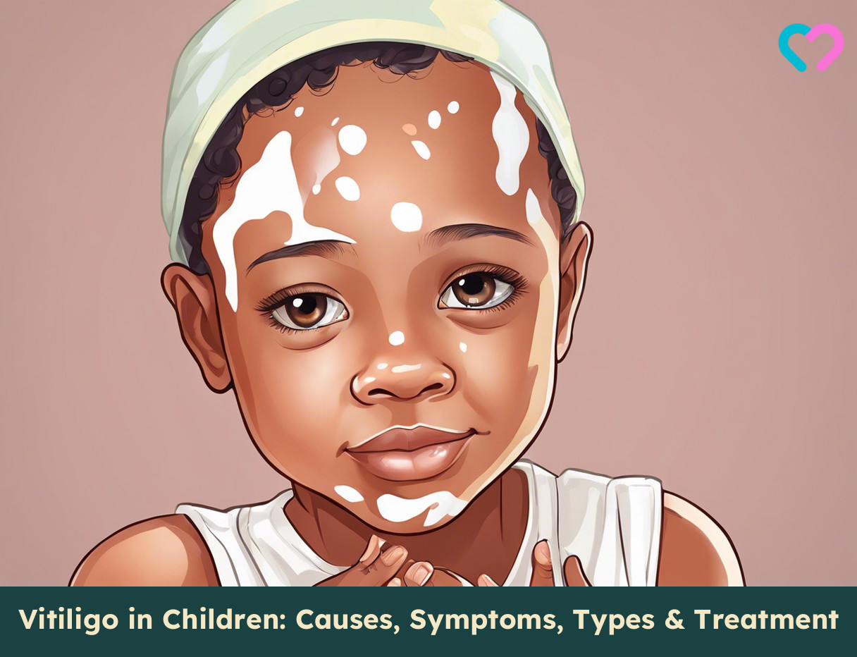 Vitiligo In Children_illustration