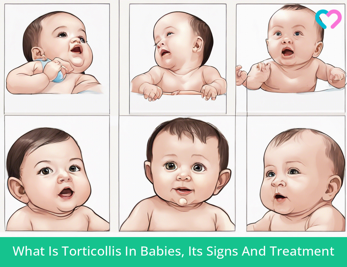 Torticollis In Babies_illustration